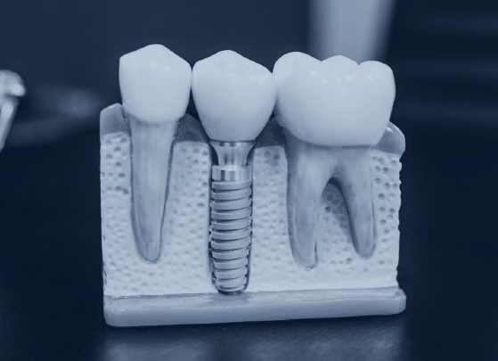 Dental Implants at Brody Family Dentistry