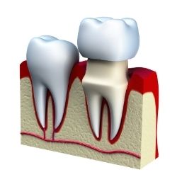 Toronto Dental Crowns Services