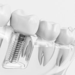 Toronto Dental Implants