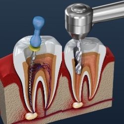 Toronto Dental Bonding & Fillings